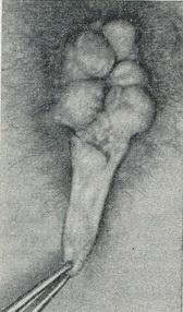 гіпертрофія анальних сосочків