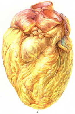 ожиріння серця