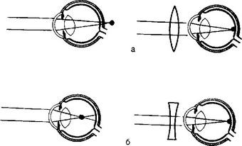 Схема оптичної корекції зору окулярами