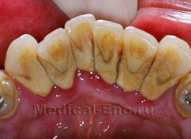 зубний камінь